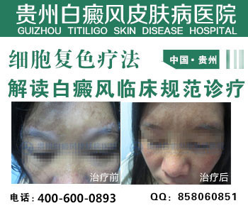 白斑最新疗法，曙光初现的希望之源，重塑肌肤健康的新希望